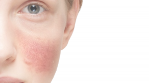 rosácea dermatoscopia